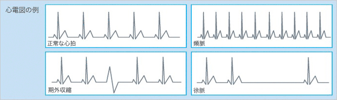 心電図の例