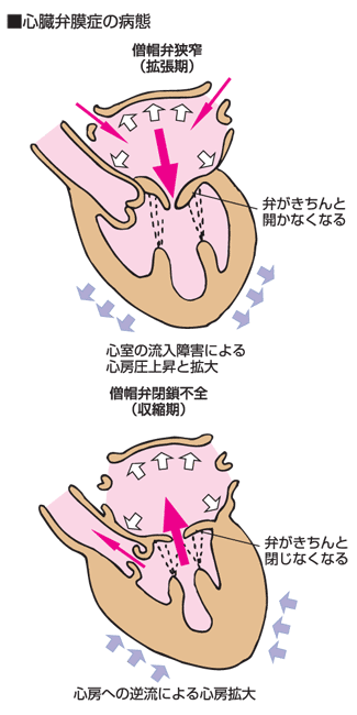 心臓の弁の異常 心臓弁膜症とは 健康アドバイス どうき 息切れ 気つけに 救心製薬株式会社